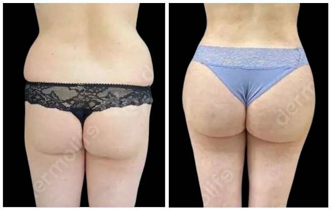 gluteoplastica clinica estetica italy 