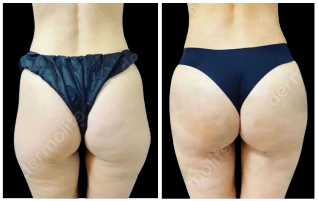 gluteoplastica esthetic clinic italy 