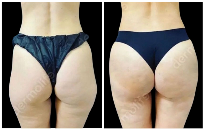 gluteoplastica clinica estetica italy 