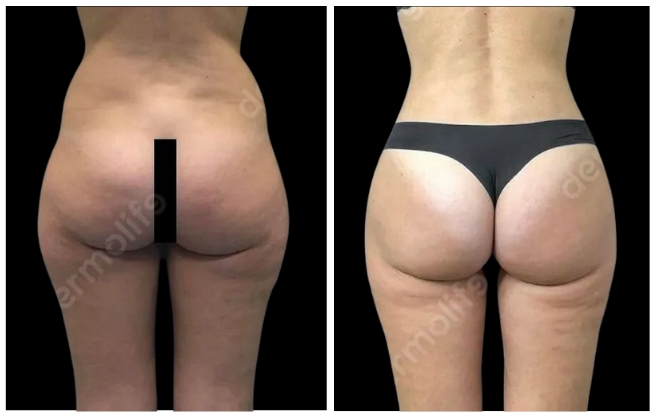 gluteoplastica clinica estetica italy 