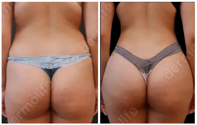 gluteoplastica clinica estetica italy 