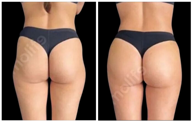 gluteoplastica esthetic clinic italy 