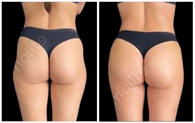 gluteoplastica clinica estetica italy 