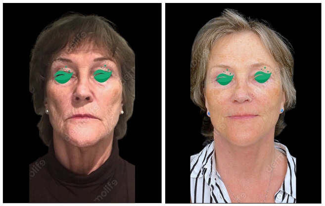 facelift aesthetic clinic italy 