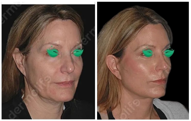 facelift aesthetic clinic italy 