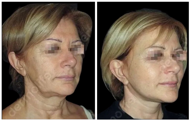 facelift aesthetic clinic italy 