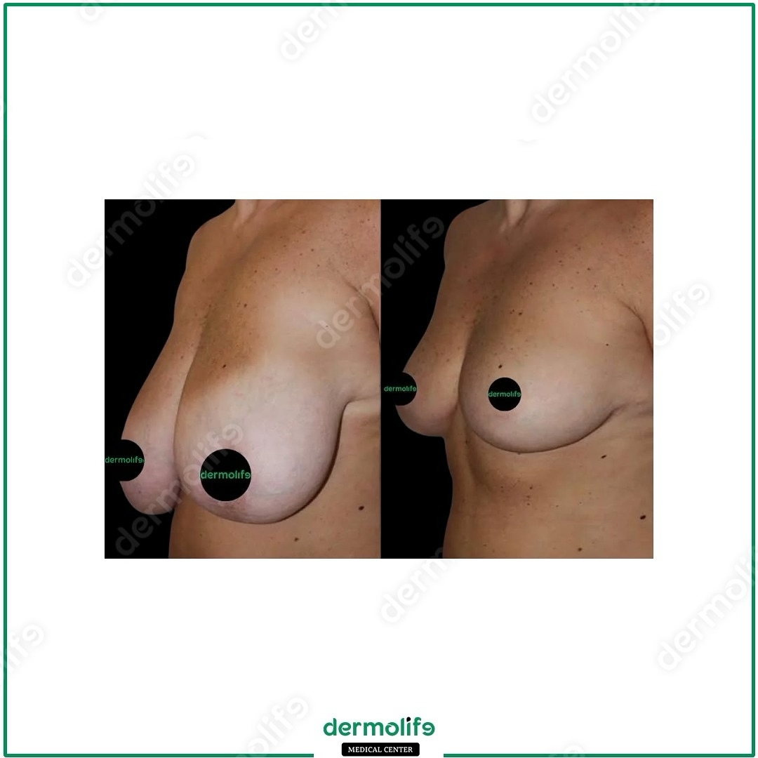 lifting del seno clinica estetica italy 