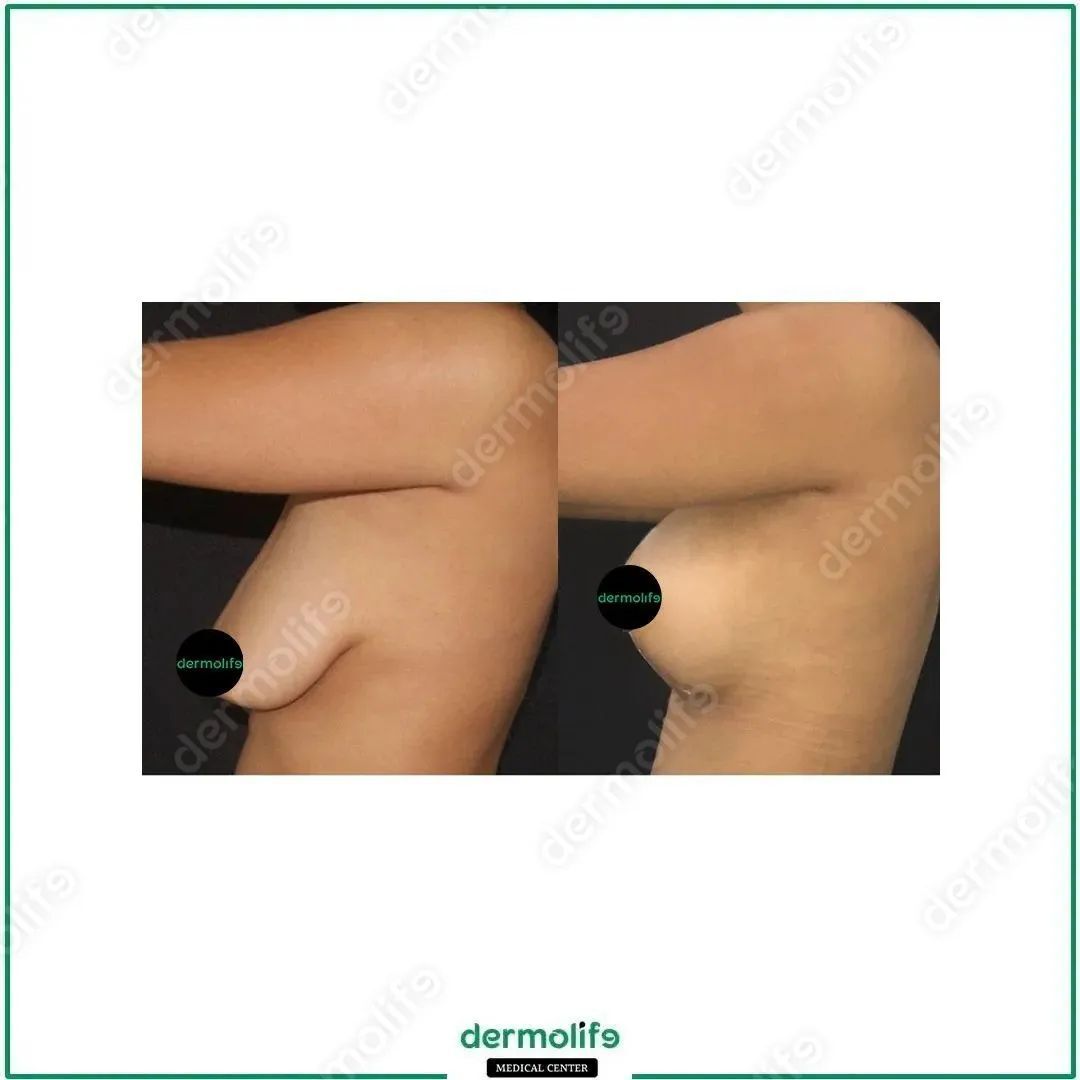 lifting del seno clinica estetica italy 1