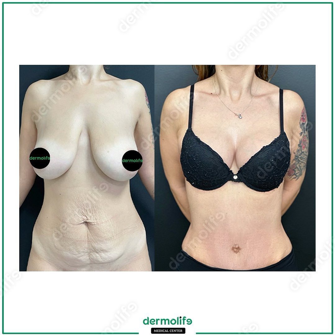 lifting del seno clinica estetica italy 1