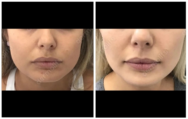 buccal lipectomy aesthetic clinic italy 