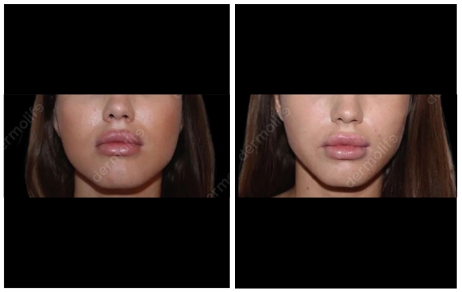 buccal lipectomy aesthetic clinic italy 