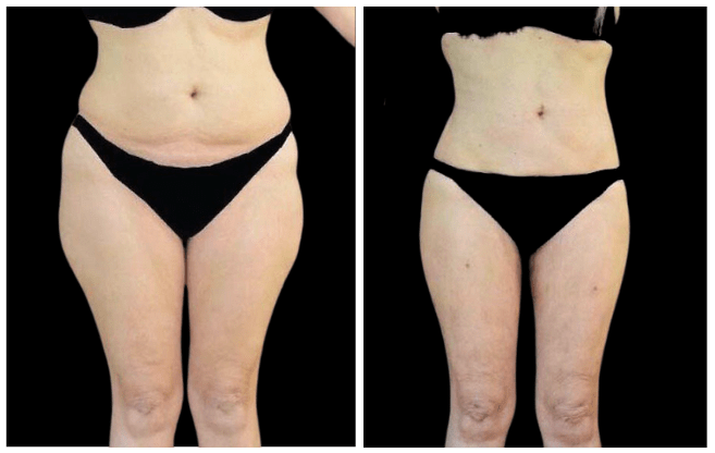 liposuzione clinica estetica italy 