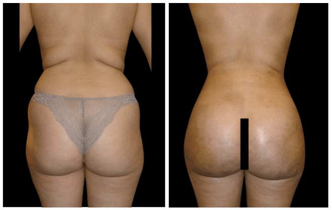 liposuzione clinica estetica italy 