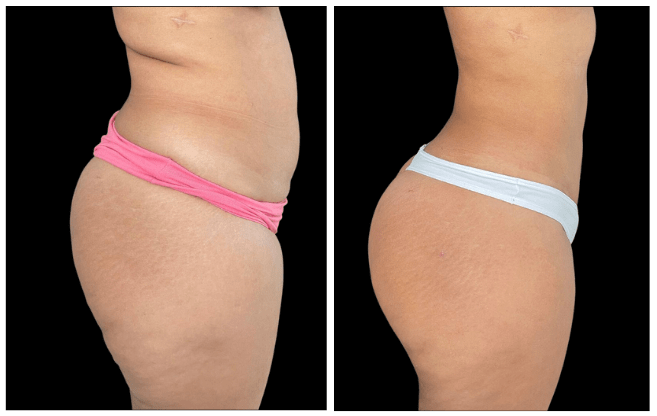 liposuction aesthetic clinic italy 