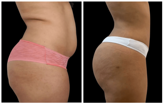 liposuzione clinica estetica italy 