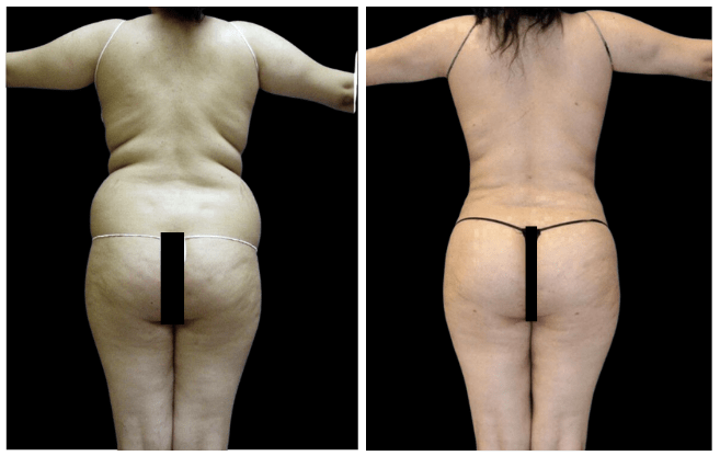 liposuction aesthetic clinic italy 