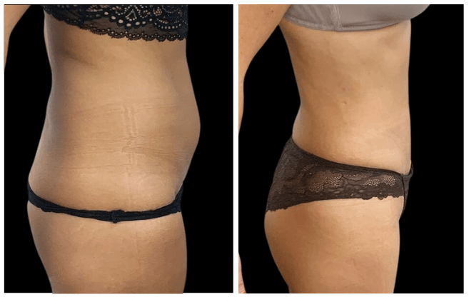 liposuction aesthetic clinic italy 