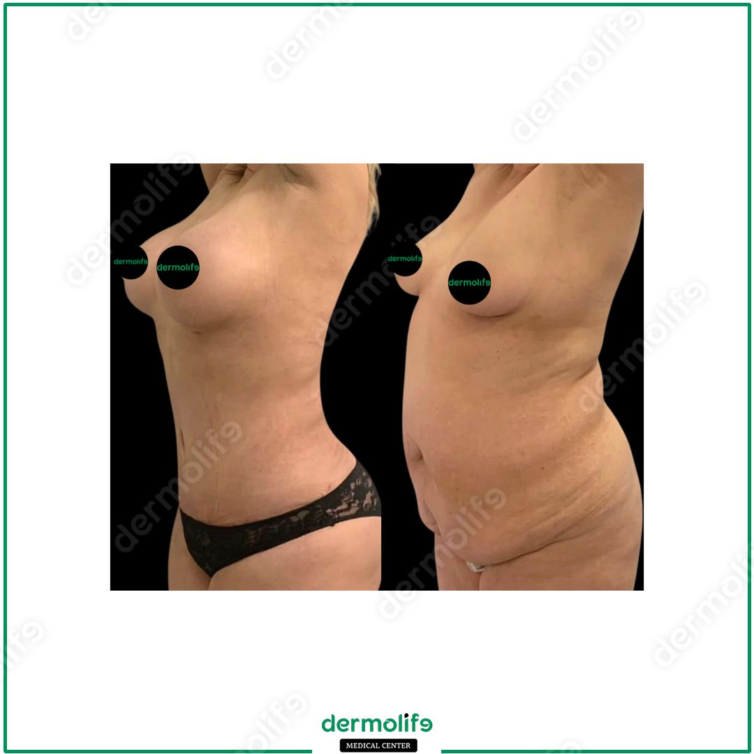 mommy-makeover clinica estetica italy 