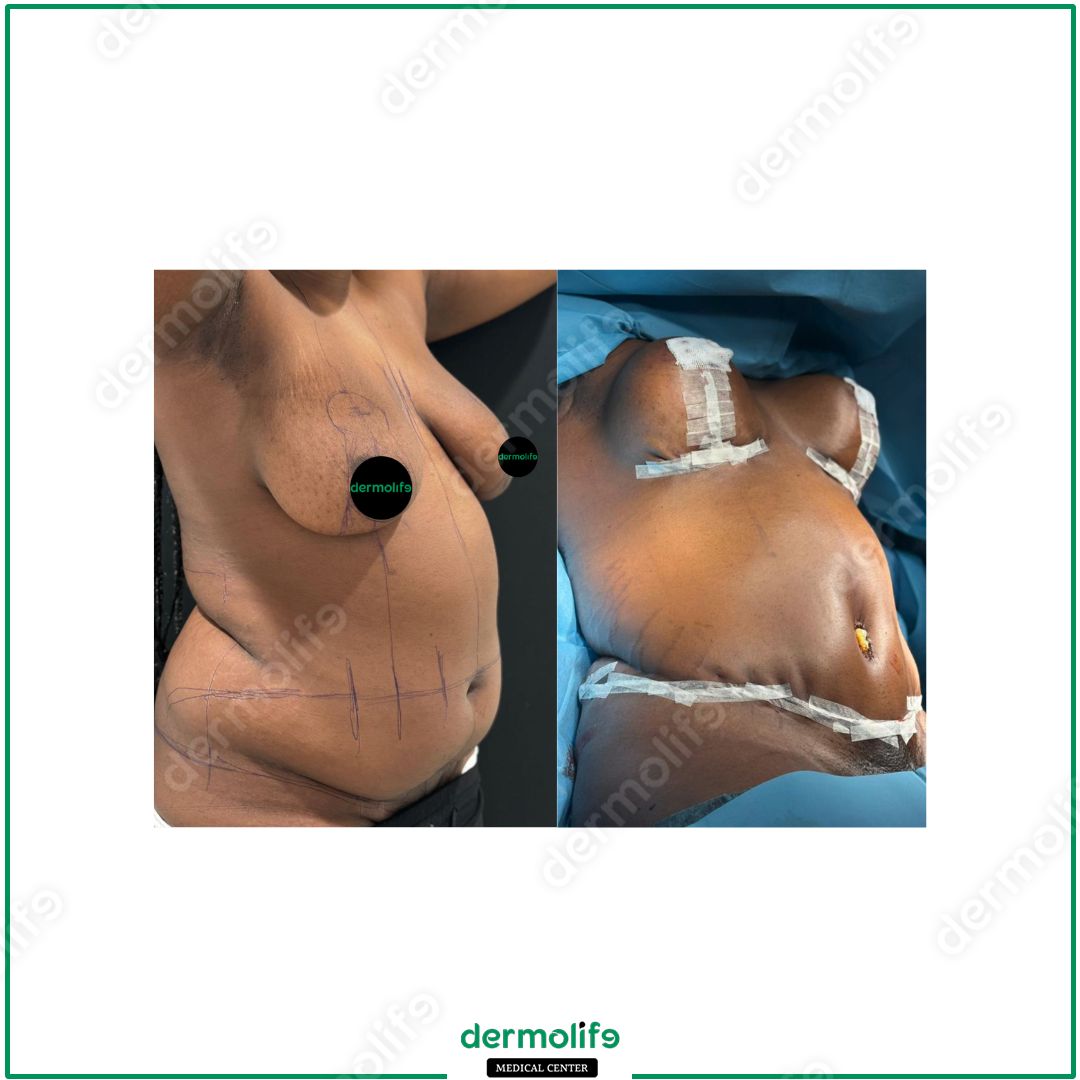 mommy-makeover clinica estetica italy 