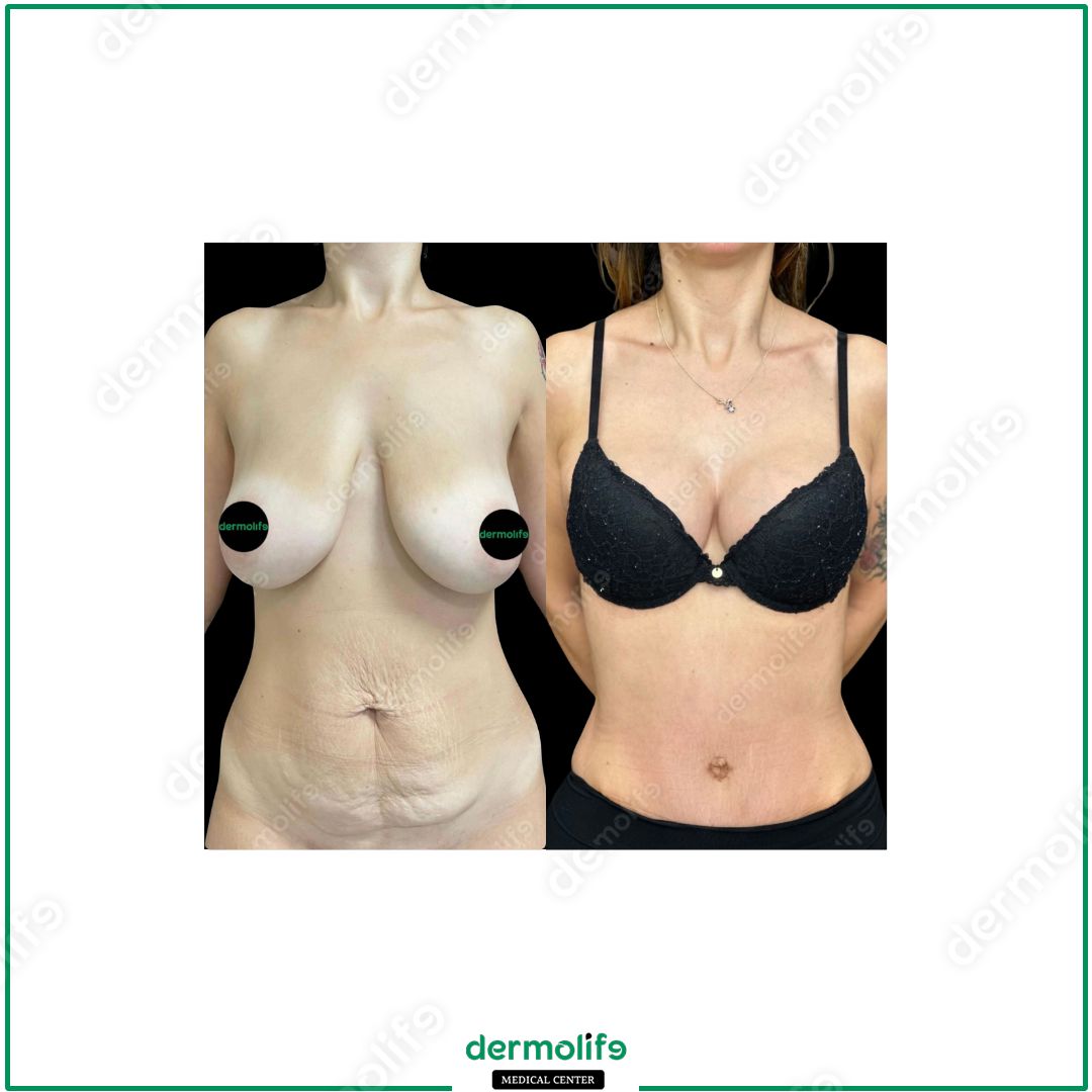 mommy-makeover clinica estetica italy 