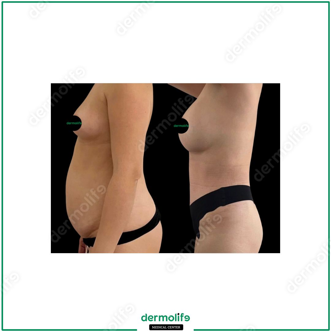 mommy-makeover clinica estetica italy 