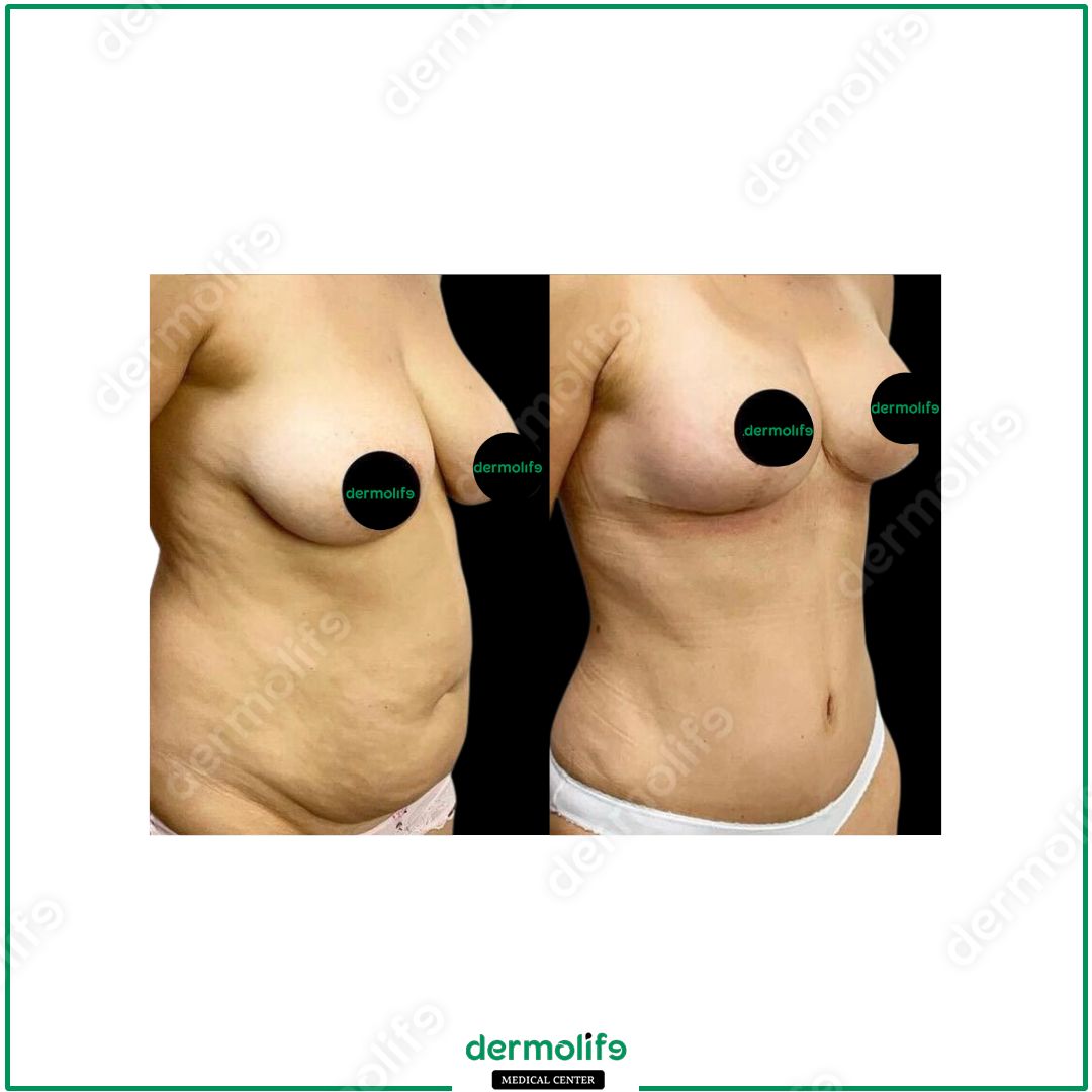 mommy-makeover clinica estetica italy 