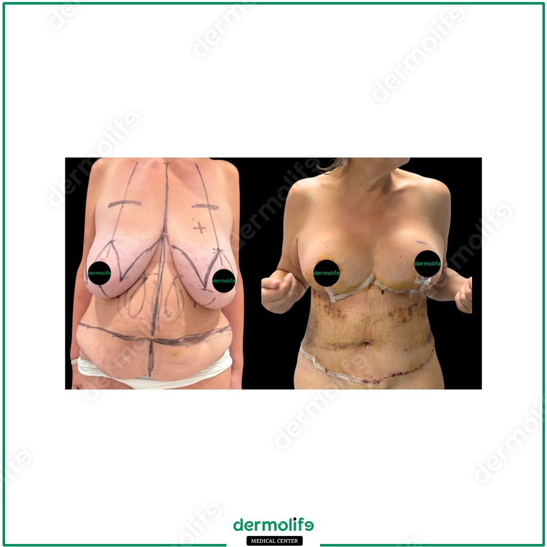 mommy-makeover clinica estetica italy 