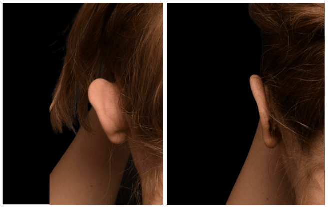 otoplasty aesthetic clinic italy 