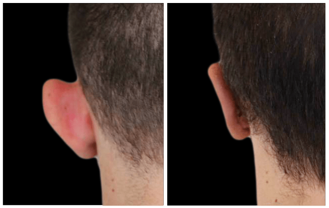 otoplasty aesthetic clinic italy 