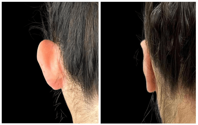 otoplasty aesthetic clinic italy 