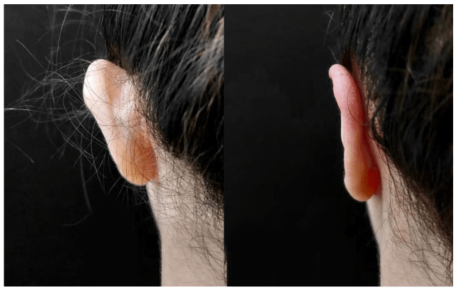 otoplasty aesthetic clinic italy 