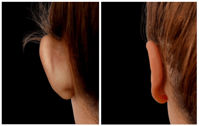 otoplasty aesthetic clinic italy 
