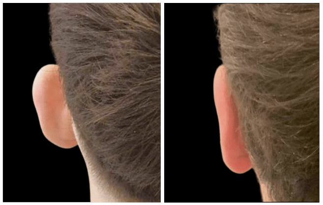 otoplasty aesthetic clinic italy 