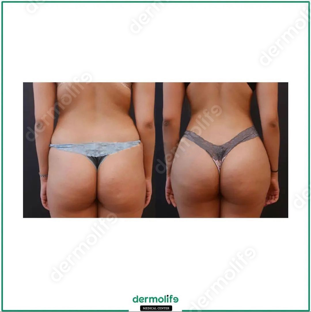 Rimodellamento Glutei clinica estetica italy 