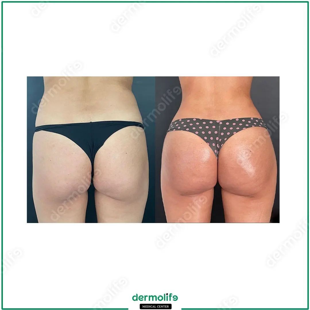 Rimodellamento Glutei clinica estetica italy 1