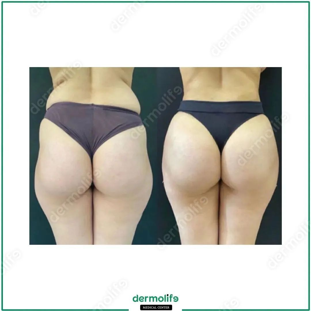 Rimodellamento Glutei clinica estetica italy 2