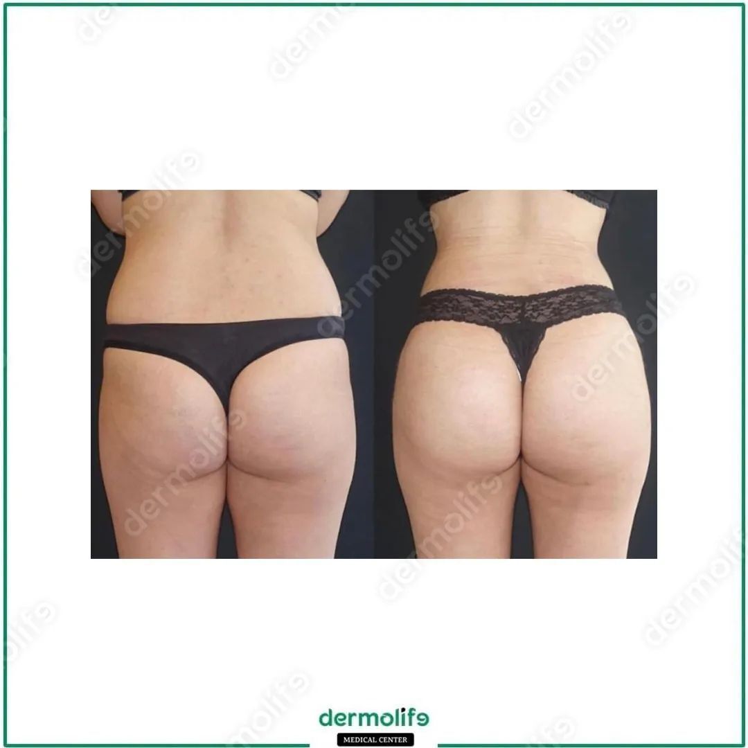 Rimodellamento Glutei clinica estetica italy 3