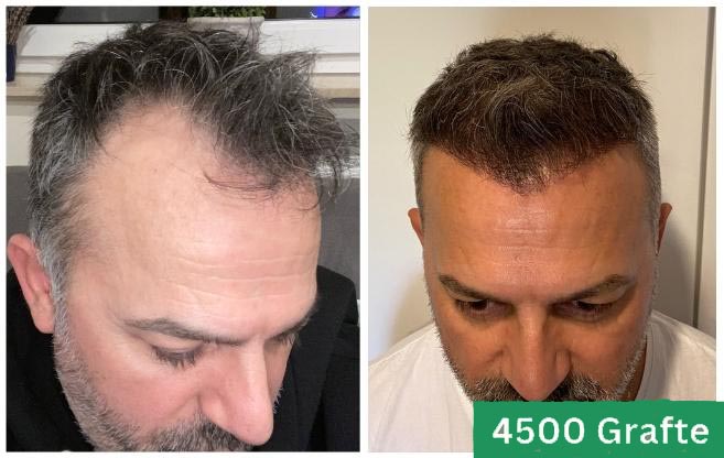 Hair transplant clinic estetica italy 