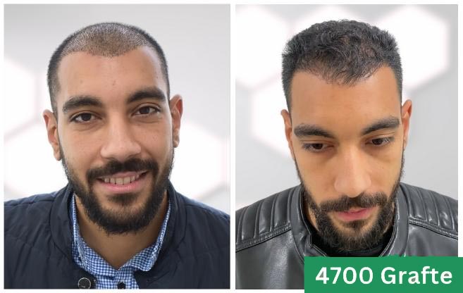 Hair transplant clinic estetica italy 